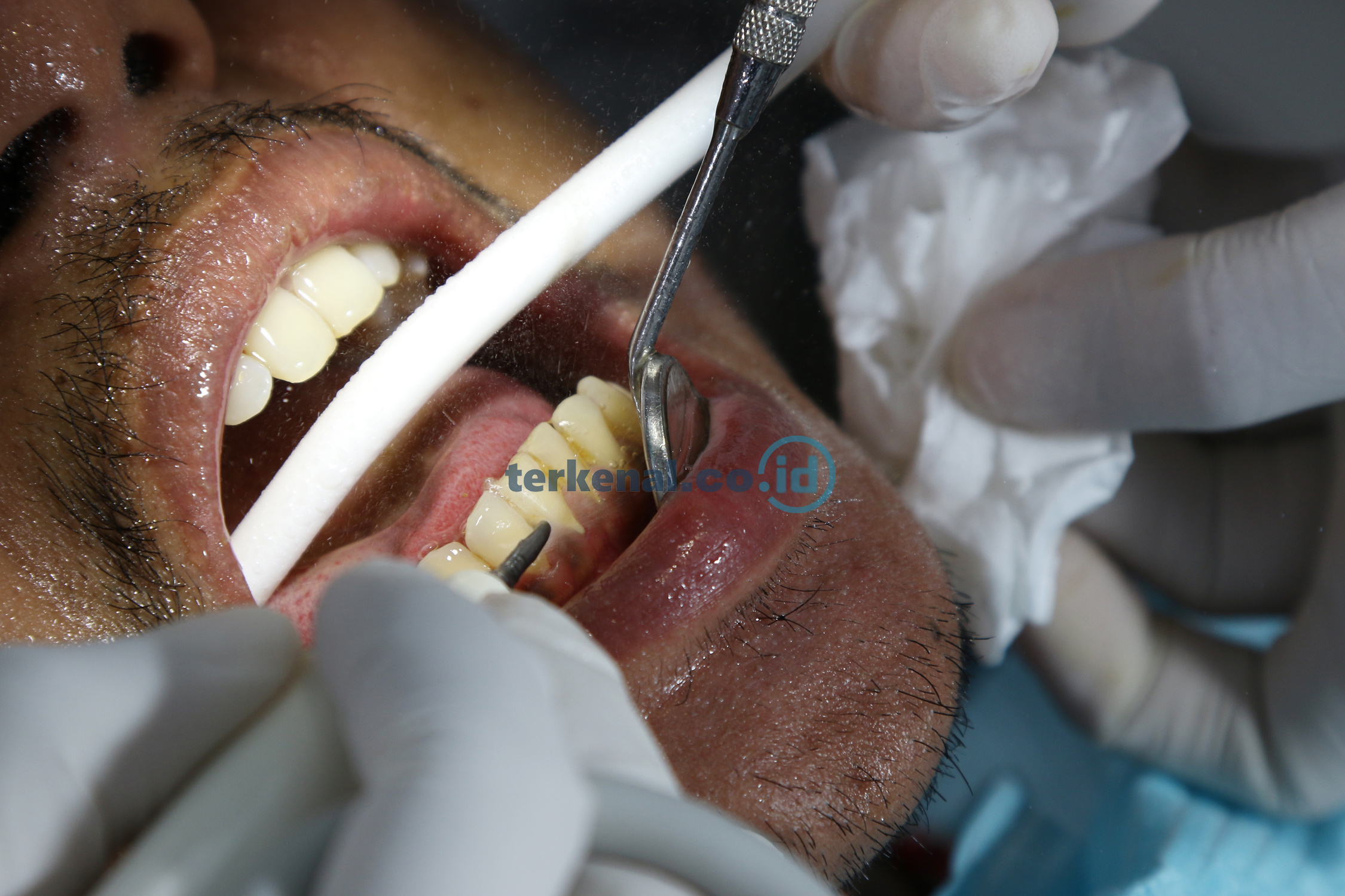 FOTO: Klinik Skincare dan Gigi Mutiara Aesthetic di Meikarta 7 57F84125 87AA 4618 8E2A 1D18434CCE70